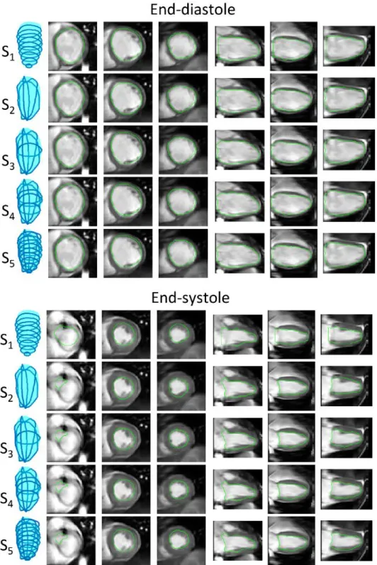 Figure  5  Example  segmentations  obtained  from  the  five  surface  reconstruction  strategies  in  one  patient  (end-diastole,  three   short-axis  and  three  reformatted   long-axis slices are shown)