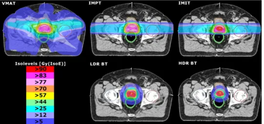 Figure 1.7: Dosimetric differences among volumetric modulated arc therapy (VMAT), inten- inten-sity modulated proton therapy (IMPT), inteninten-sity modulated carbon-ion therapy (IMIT), low dose rate brachytherapy (LDR-BT) and high dose rate brachytherapy 