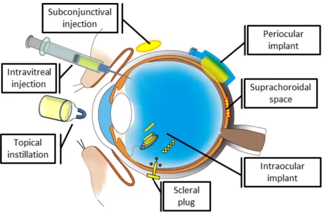 Figure 1.6: Examples of drug delivery systems and devices for the posterior segment of the  eye