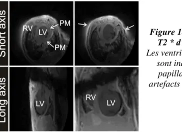 Figure 18 - Images IRM pondérées en  T2 * d'un cœur de souris post-IM.  