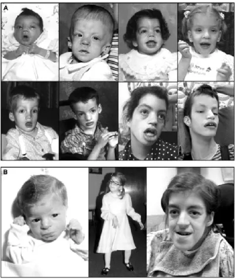 Figure 10: The PMSE syndrome: dysmorphic features 