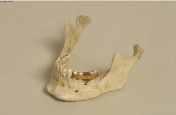 Figure 1.8 : Copie d'un appareil en or sur une mâchoire inférieure, destiné à immobiliser des  dents