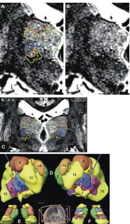 Figure 2. 3D stereotactic planning for targeting of the ventrointermediate nucleus (Vim), after manual outlining of  thalamic nuclei (iPlan, BrainLab, Germany); from (A) to (F), same patient: (A) manual outlining of thalamic nuclei  according  to  anatomic