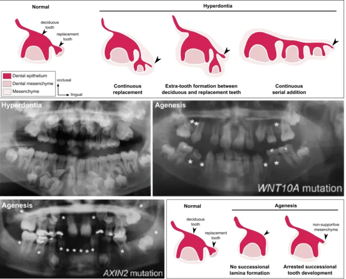 Figure I. 6. Tooth number abnormalities in humans: hyperdontia and agenesis. At the top, schematics  of possible mechanisms leading to tooth hyperdontia: continuous replacement, extra-tooth formation or  continuous serial addition