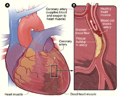 Figure 1.4: Infarct. [A] overview of the coronary system; [B] cross-section of the coronary artery with details on the occlusion process