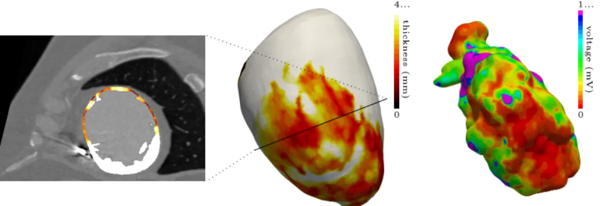 Figure 2.3: (Left-Middle) Wall thickness as dened in section 2.1.2.4. (Right) Volt- Volt-age map recorded during sinus rhythm.