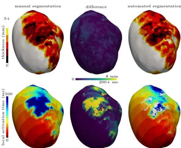 Figure 2.15: Impact of the automated segmentation on the thickness and activation maps for two dierent patients