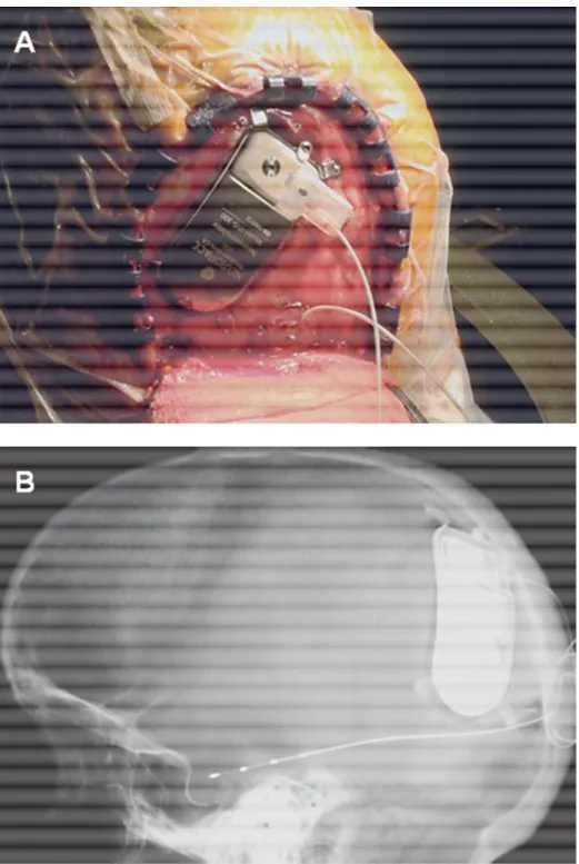 Figure  3  :  Images  du  système  Neuropace.  (A)  montrant  le  générateur  d'impulsion  connecté  à  sa  position  finale,  (B)  une  radiographie  post-opératoire  du  générateur  d'impulsion  et  de  l’électrode  implantée  dans  l’hippocampe
