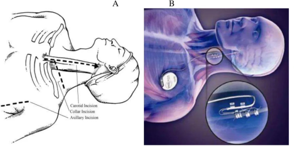Figure 11 : Vagus Nerve Stimulation 