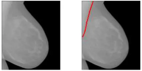 Figure 4 -  Délimitation entre muscle et sein peu marquée 