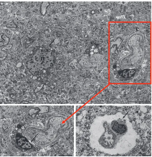 Figure 3: Capillaire collabé après TC avec image d'œdème périvasculaire (Menon et al. CCM 2004) 
