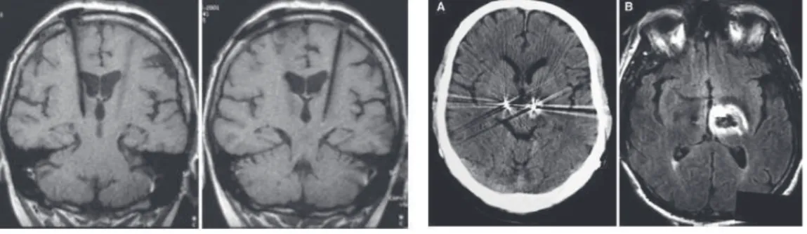 Figure 2.4.1 – Deux cas de lésions neurologiques suite à des examens IRM en présence de dispositifs SCP (extraites de [Spiegel et al., 2003] et [Henderson et al., 2005]).