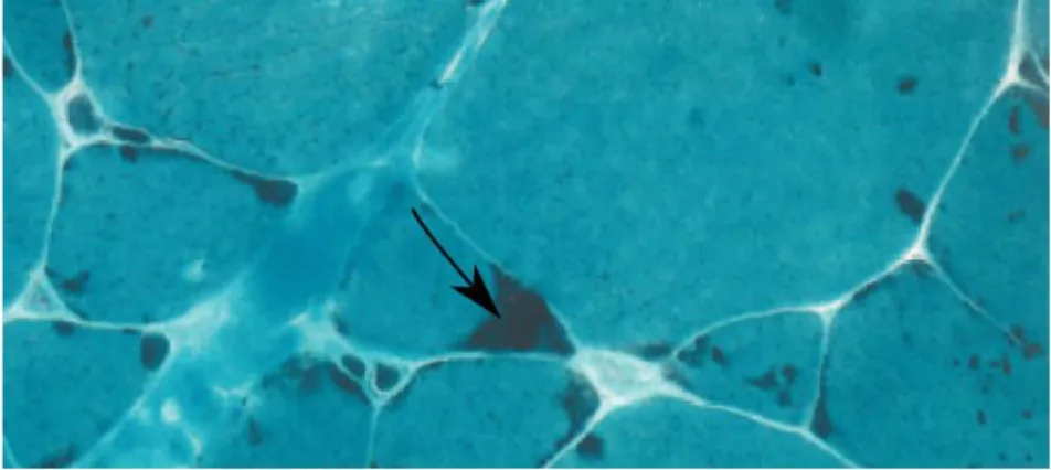 Figure  24  Myopathie  {  nemaline.  Fibre  musculaire  en  coupe  transversale  La  flêche  indique  les  batonnets  retrouvés  ici  en  périphérie  cellulaire  