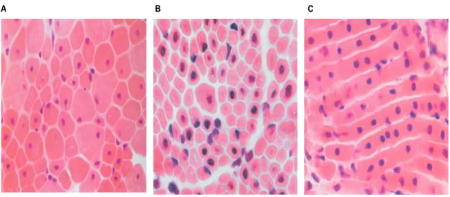 Figure  25 Myopathie centronucléaire et myotubulaire. 