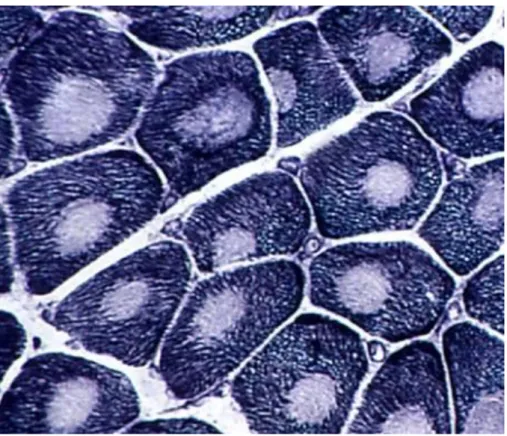 Figure 26 Myopathie { cores centraux. Coloration NADH-TR (tetrazolium réductase) 