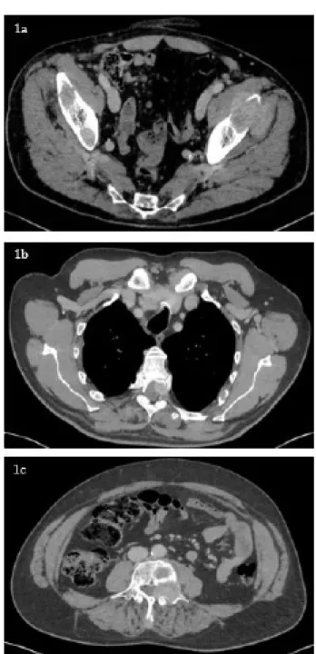 Figure 2: June 2018 MRI in sagittal section confirming epiduritis  caused  by  metastatic  recurrences