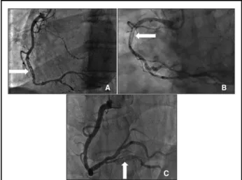Figure 1.    The 3 angiographic aspects of recanalized coronary  thrombus in the present cohort: (A) braided, (B)  pseudo-dissection, (C) veiled/hazy (white arrows).
