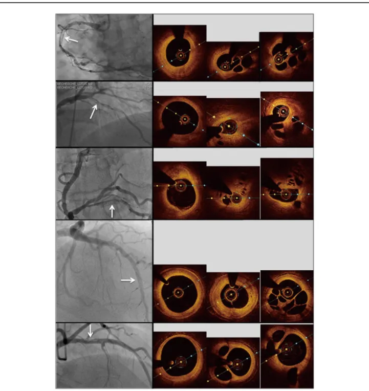 Figure 3.    Five recanalized coronary thrombi on angiography (white arrows) and optical coherence tomography, with (left to right)  reference segment slice with minimum lumen area measured after mm/mm analysis of pull-back, and 1 representative transverse