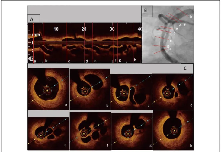 Figure 4.    Recanalized coronary thrombus on angiography vs. optical coherence tomography (OCT): each (C) transverse OCT  slice (a–h) is located on the respective slices on (A) longitudinal OCT and (B) angiography by red lines.