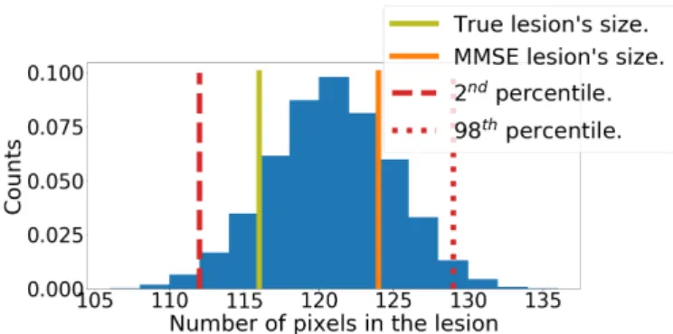 Figure 16: Histogram of the estimated lesion’s size in the samples generated by PnP-ULA