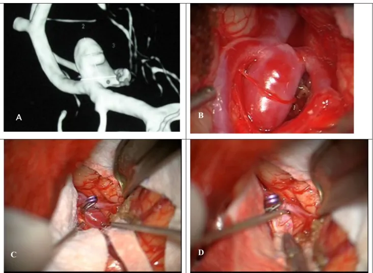 Fig. 1. (A) Three-dimensional rotational angiography imaging from Aneurysm #9. (B) Surgical  view of this aneurysm in Middle Cerebral Artery location before clipping