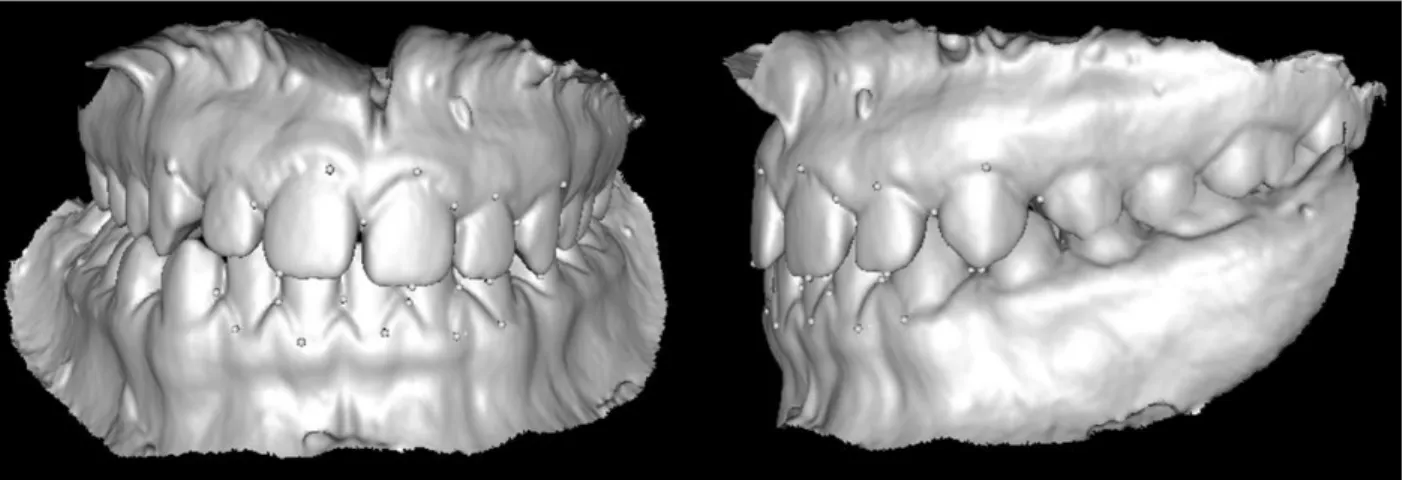 Figure  10.  Final  registration  of  mandible  for  an  automatic  thresholding  outline  case  with  an  optimization  of  2D  point  positions step