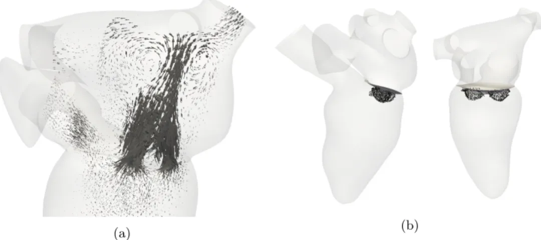 Figure 6: (a) Blood flow during systole for case C05 T1 and (b) associated isovelocity surface in the convergence region, at an aliasing velocity of 35 cm s −1 , represented as a point cloud.