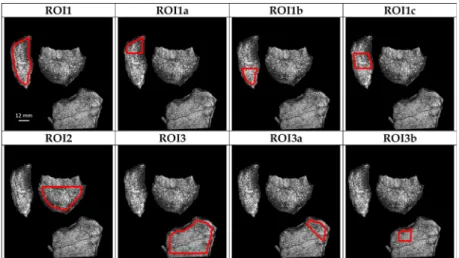Fig 2. ROIs identification. PsA patient after treatment BVF maps showing the multiple ROIs identified in red.