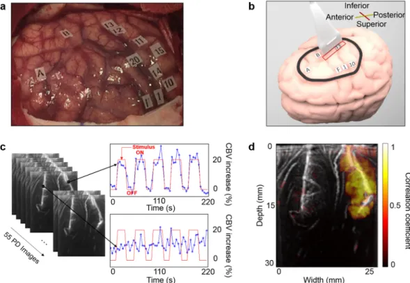 Figure 1.  Intraoperative fUS imaging of “mouth sensitive”-evoked brain activation in one patient
