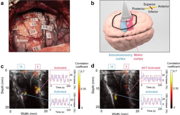 Figure 2.  Comparison between the intraoperative functional imaging of the motor and the somatosensory  cortices