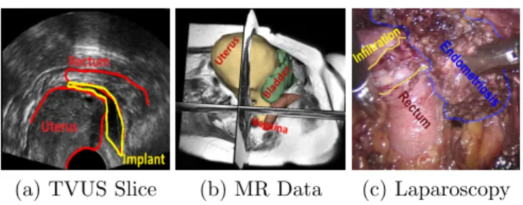 Figure 1: The most commonly used imaging modalities for detecting endometriosis.