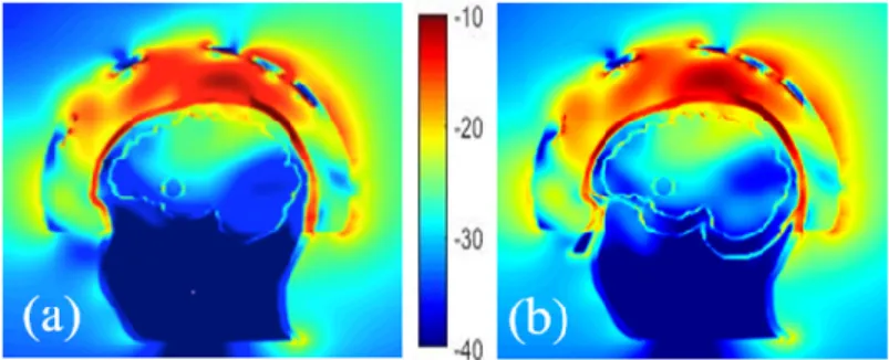 Figure 8. Comparison of the normalized E-field distribution inside and outside of head phantoms  with a stroke, composed of 2 cavities (a) and 3 cavities (b)