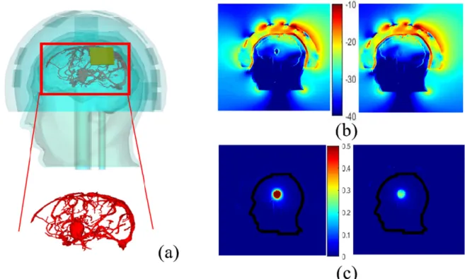 Figure 9. Head phantom including brain vessels and an elliptical stroke inside (a). Normalized magnitude of the E- field  inside and outside the head by taking blood vessels into account and the elliptical stroke, surrounded by ABS (b, left),  with no ABS 