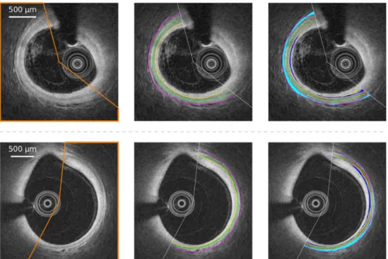 Fig. 4 Representative examples of segmentation results, for SJM-OCT (top row) and Terumo-OCT (bottom row) patients