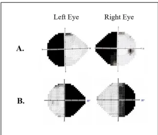 Figure 1. Illustration of the visual field deficit in left HH (A) and right HH (B): Humphrey Automated  visual perimetry from two hemianopic patients, in both eyes