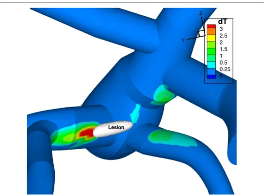 Figure 10 Effect of acoustic streaming on the temperature distribution. Temperature difference on the portal vein wall with and without acoustic streaming, t = 1.7 s, P = 6 MPa, lesion is drawn in white