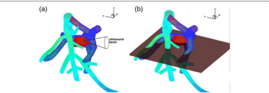 Figure 2 Geometry of the problem. (a) Schematic of the portal vein (dark blue), hepatic vein (light blue), ultrasound beam and tumor (red)