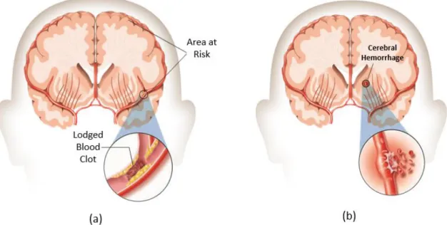 Figure 9: Illustration of stroke causes [23]: a) Ischemic stroke, and b) Hemorrhagic stroke