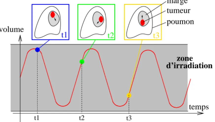 Figure 1.10 – Optimisation des marges de sécurité en fonction du mouvement pulmonaire