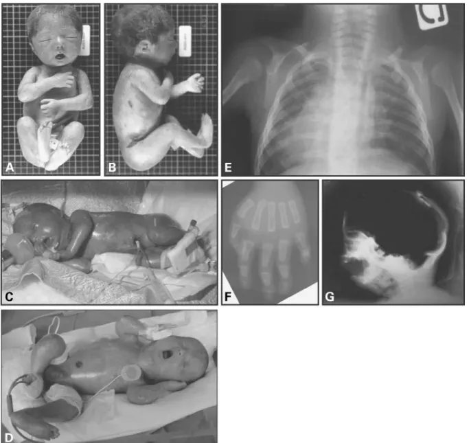 Figure 1. Clinical and radiological aspects of different patients affected with RD. Typical fixed facial expression, micrognathism and mouth in the ‘o’ position are observed in these three cases