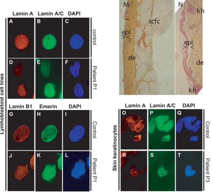Figure 4. Immunohistochemical and histological phenotypes of patients P1 and P3. (A – L): EBV immortalized lymphoblastoid cells from control (A – C, G – I) and patient P1 (D – F, J – L)