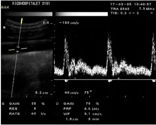 Figure 1.9 – Duplex scan showing both B-mode image and spectrogram of the carotid artery
