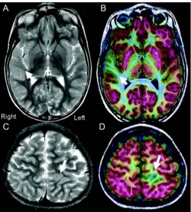 Figure 3.2: Examples of two patients with FCD type I. Both patients (shown row-wise) had normal MRI reading (left column)
