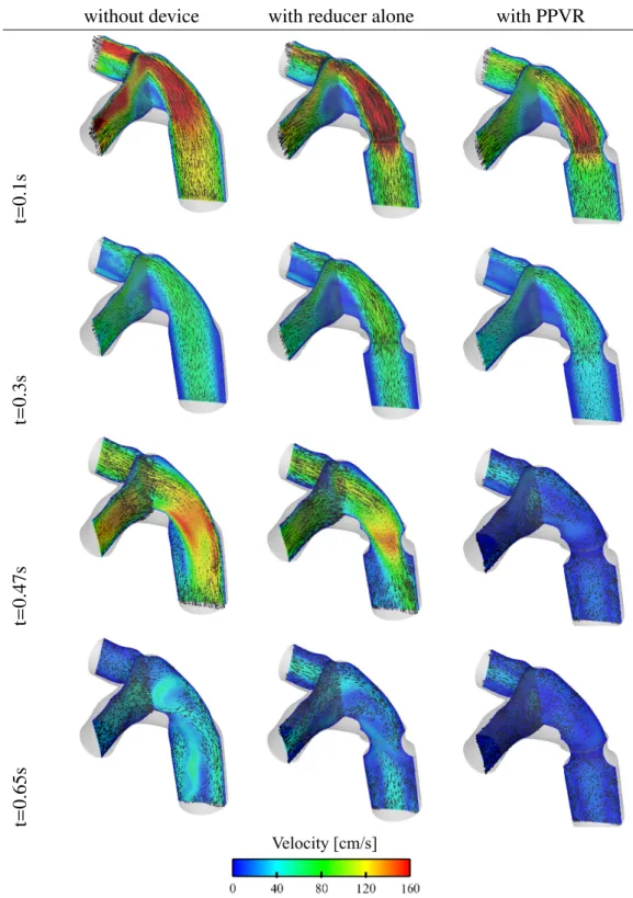 Figure 7: Velocity field snapshots on longitudinal cuts at selected instants (from top to bottom: t = 0.1, 0.3, 0.47, 0.65 s) during the cardiac cycle
