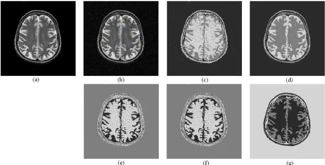 Fig. 4.10 – L’image m´ edicale avec le bruit Gaussien et les r´ esultats de segmentation (c=3).