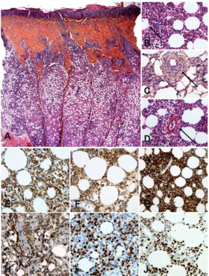 Fig. 1. Histological and phenotypic analyses of subcutaneous panniculitis-like  T-cell lymphoma (SPTCL)