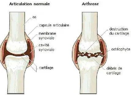 Figure 2 : Articulations saine et arthrosique (16) 
