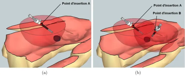 Figure 1.8 – La contrainte du point d’insertion est illustrée par la demi-sphère (rouge) décrivant l’espace atteignable par l’extrémité de l’endoscope (a)