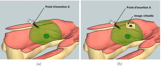 Figure 2.1 – Plus de contrainte du point d’insertion. L’espace atteignable par la vue proposée est représenté par une demi-sphère (verte) centrée sur l’organe d’intérêt (a)