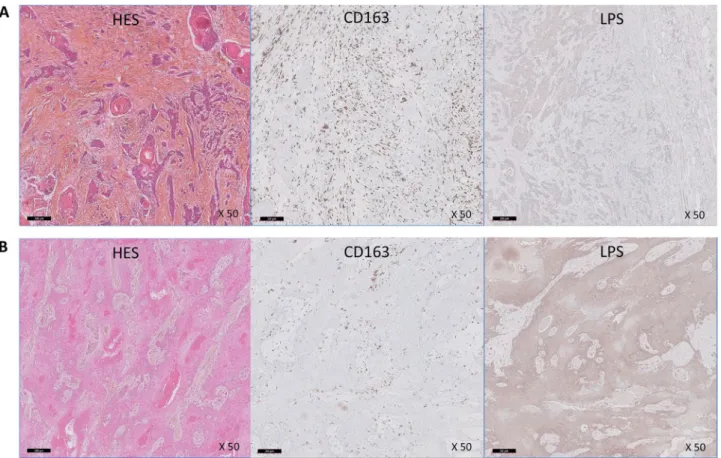 Figure 5.  Representative pictures of infiltrating squamous cell carcinomas of the oropharynx: hematoxylin–